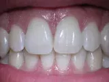 Hoe houd je je gebit gezond en mooi door tandbederf te voorkomen